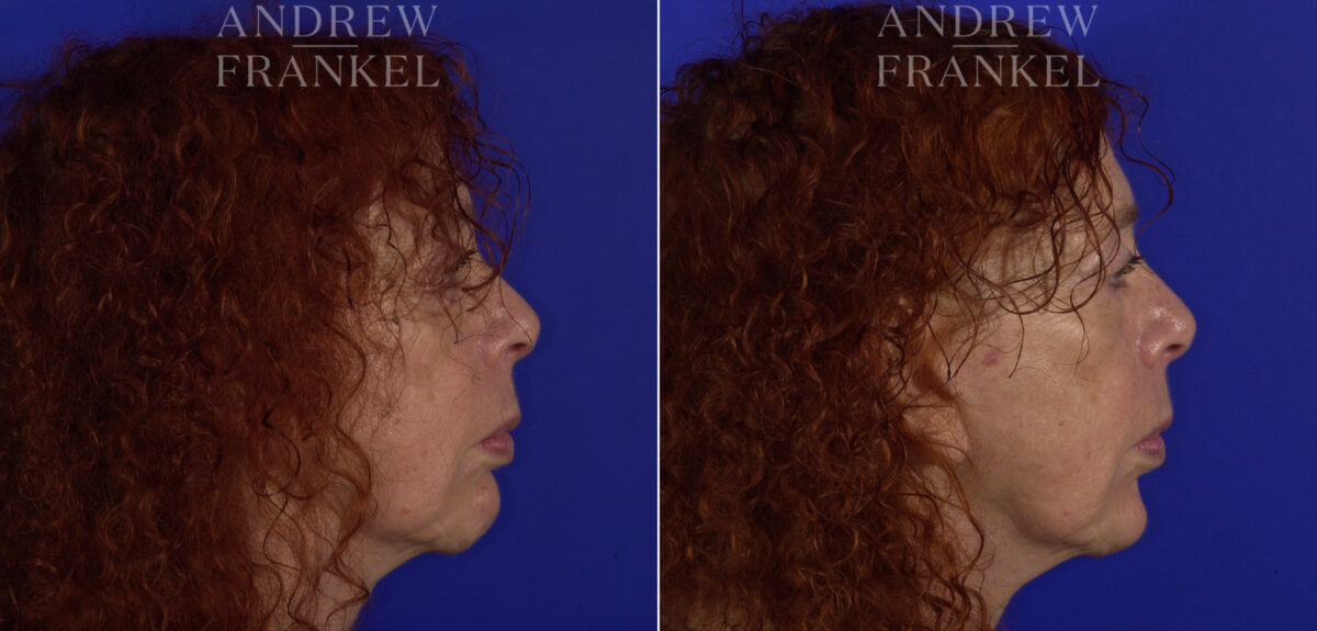 Non-Surgical Jawline Enhancement before and after photos in Beverly Hills, CA, Patient 23581