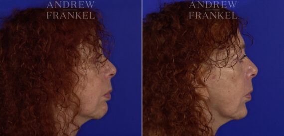 Non-Surgical Jawline Enhancement before and after photos in Beverly Hills, CA, Patient 23581
