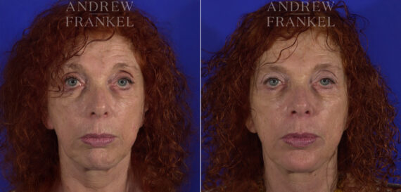 Non-Surgical Jawline Enhancement before and after photos in Beverly Hills, CA, Patient 23581