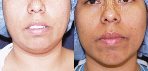 Non-Surgical Jawline Enhancement before and after photos in Beverly Hills, CA, Patient 23588