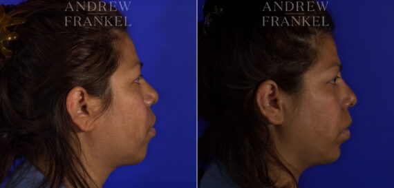 Non-Surgical Jawline Enhancement before and after photos in Beverly Hills, CA, Patient 23595