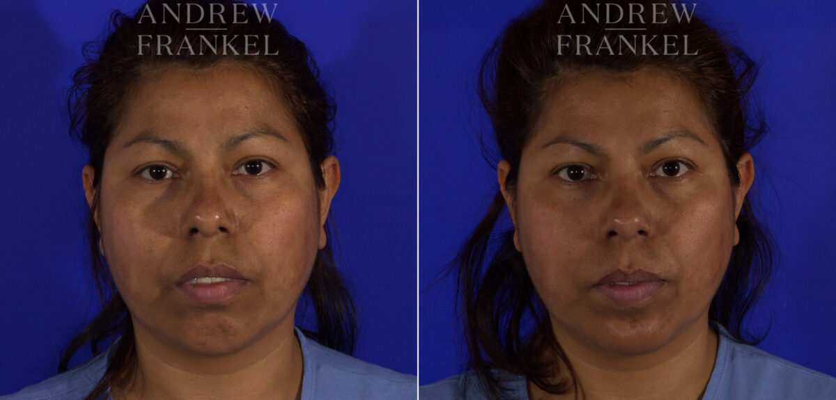 Non-Surgical Jawline Enhancement before and after photos in Beverly Hills, CA, Patient 23595