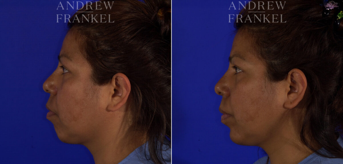 Non-Surgical Jawline Enhancement before and after photos in Beverly Hills, CA, Patient 23595