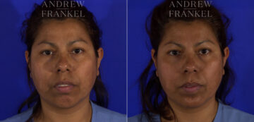 Non-Surgical Jawline Enhancement before and after photos in Beverly Hills, CA, Patient 23595