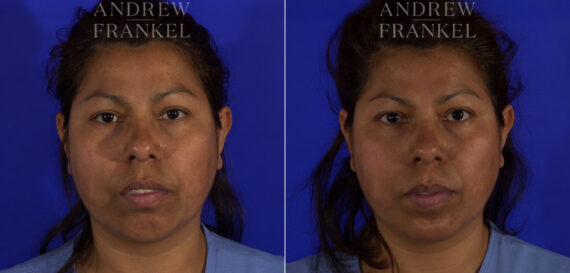 Non-Surgical Jawline Enhancement before and after photos in Beverly Hills, CA, Patient 23595