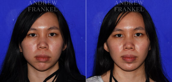 Non-Surgical Jawline Enhancement before and after photos in Beverly Hills, CA, Patient 23606