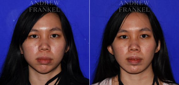 Non-Surgical Jawline Enhancement before and after photos in Beverly Hills, CA, Patient 23606