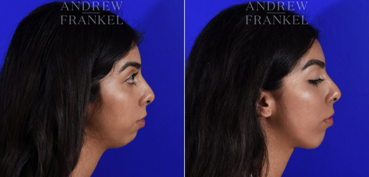 Non-Surgical Jawline Enhancement before and after photos in Beverly Hills, CA, Patient 23612