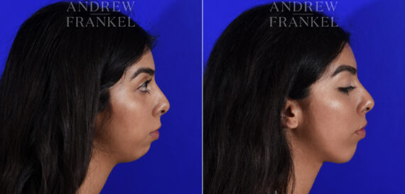 Non-Surgical Jawline Enhancement before and after photos in Beverly Hills, CA, Patient 23612