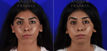 Non-Surgical Jawline Enhancement before and after photos in Beverly Hills, CA, Patient 23612