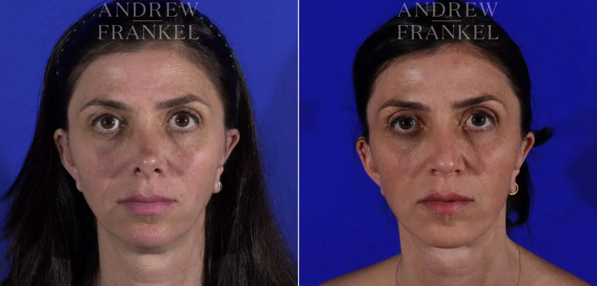 Non-Surgical Jawline Enhancement before and after photos in Beverly Hills, CA, Patient 23619
