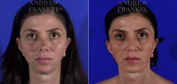 Non-Surgical Jawline Enhancement before and after photos in Beverly Hills, CA, Patient 23619