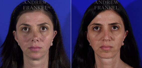 Non-Surgical Jawline Enhancement before and after photos in Beverly Hills, CA, Patient 23619
