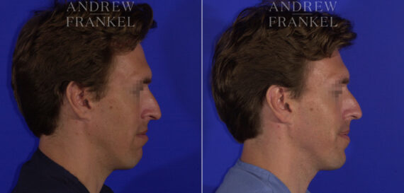 Non-Surgical Jawline Enhancement before and after photos in Beverly Hills, CA, Patient 23551