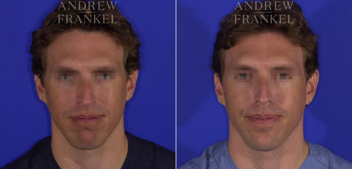 Non-Surgical Jawline Enhancement before and after photos in Beverly Hills, CA, Patient 23551