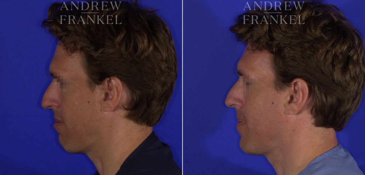Non-Surgical Jawline Enhancement before and after photos in Beverly Hills, CA, Patient 23551