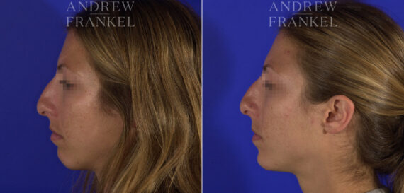 Non-Surgical Jawline Enhancement before and after photos in Beverly Hills, CA, Patient 23564