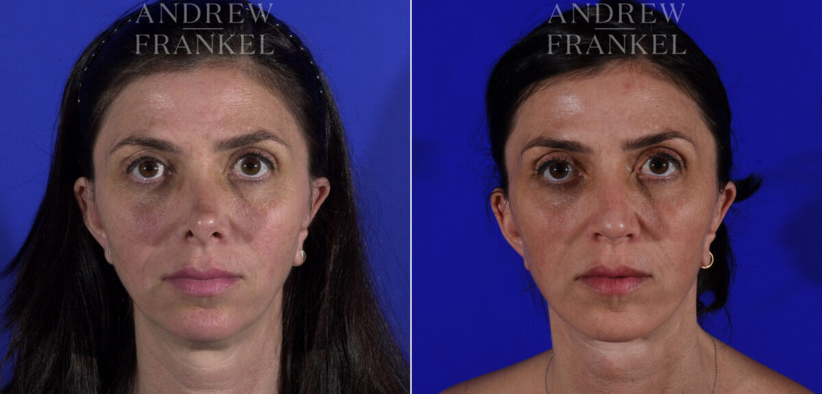 Non-Surgical Jawline Enhancement before and after photos in Beverly Hills, CA, Patient 23619
