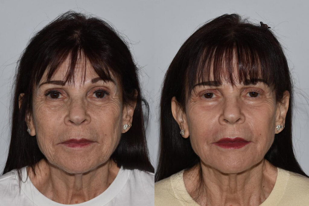 Before & After CO2 Laser procedure photo patient