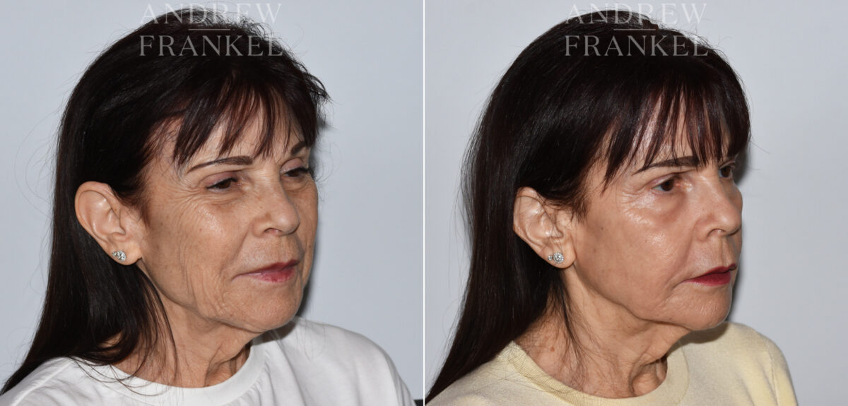 Laser Skin Rejuvenation before and after photos in Beverly Hills, CA, Patient 24086