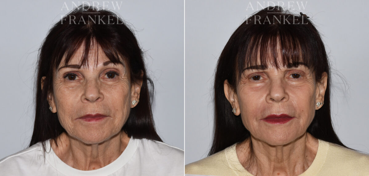 Laser Skin Rejuvenation before and after photos in Beverly Hills, CA, Patient 24086