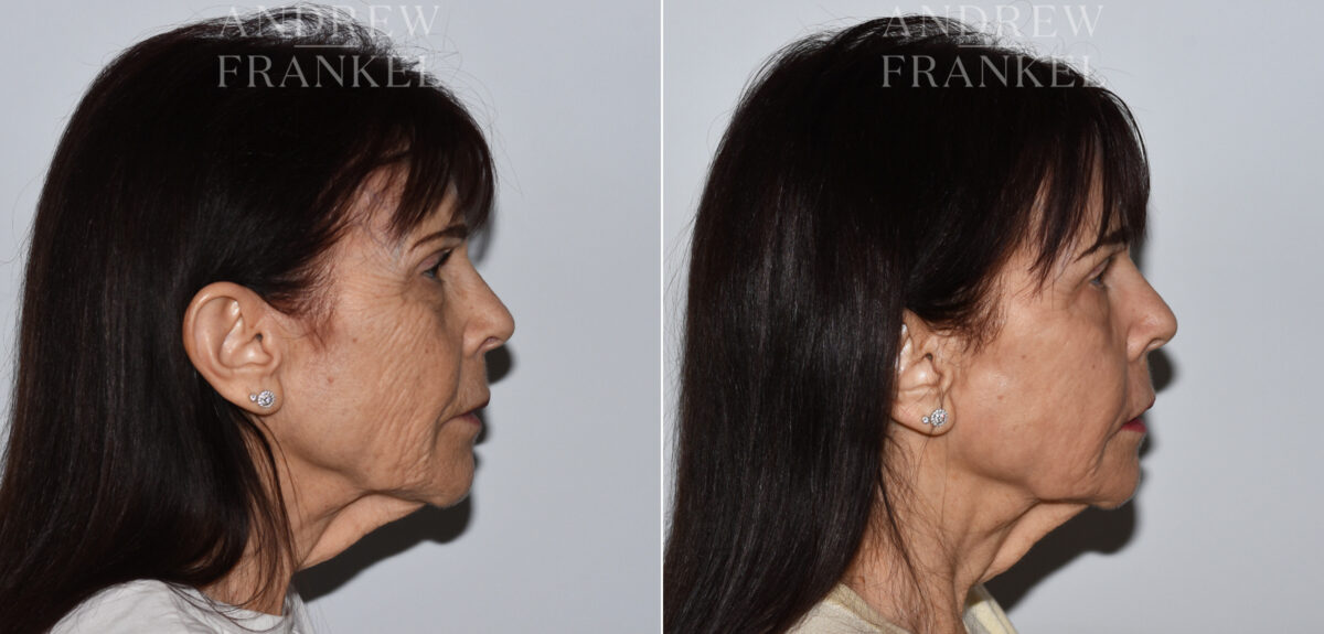 Laser Skin Rejuvenation before and after photos in Beverly Hills, CA, Patient 24086
