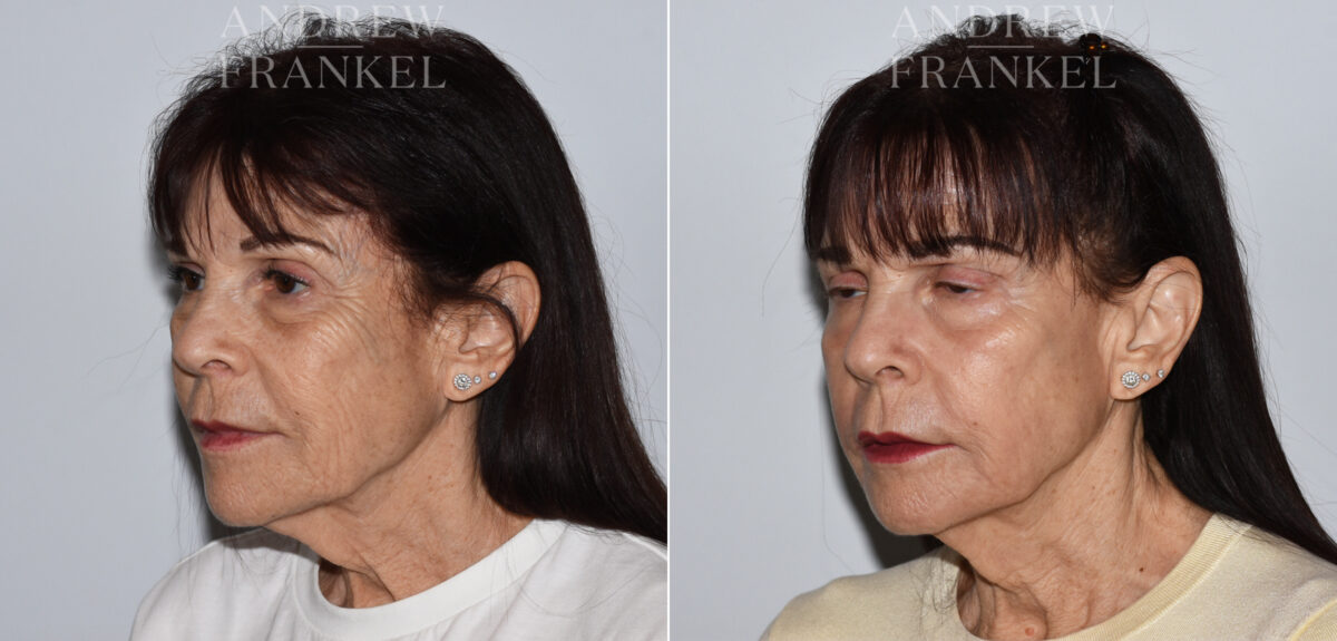 Laser Skin Rejuvenation before and after photos in Beverly Hills, CA, Patient 24086
