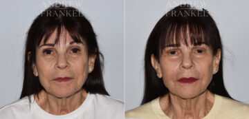 Laser Skin Rejuvenation before and after photos in Beverly Hills, CA, Patient 24086