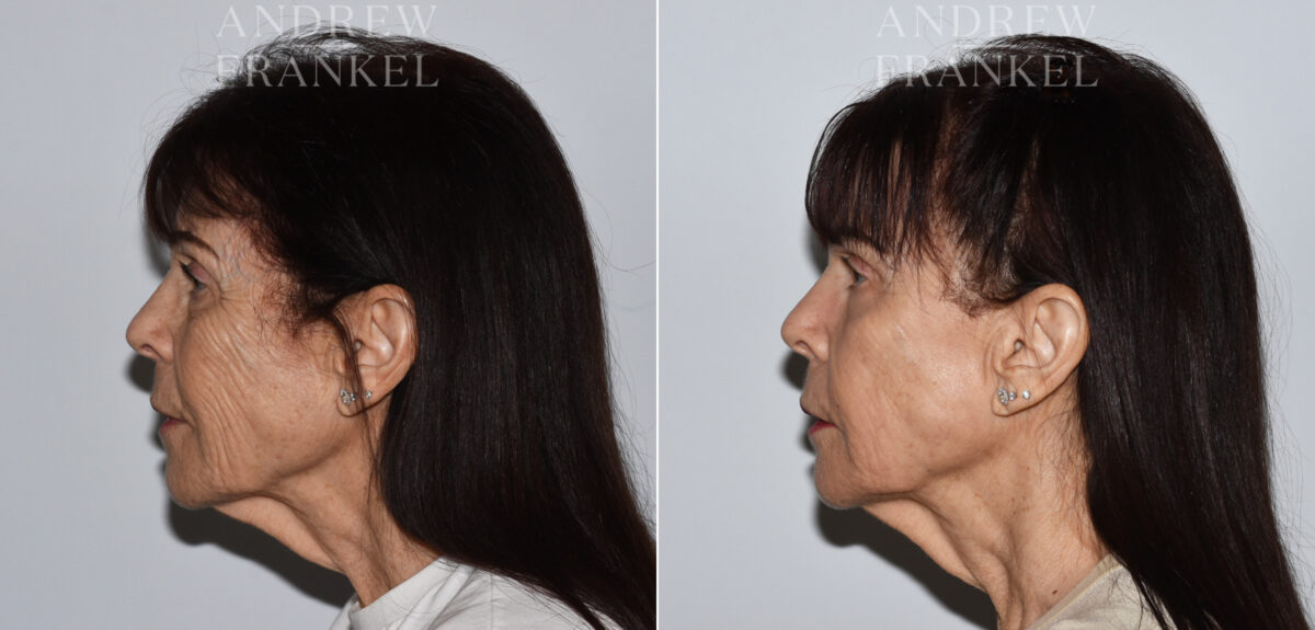 Laser Skin Rejuvenation before and after photos in Beverly Hills, CA, Patient 24086