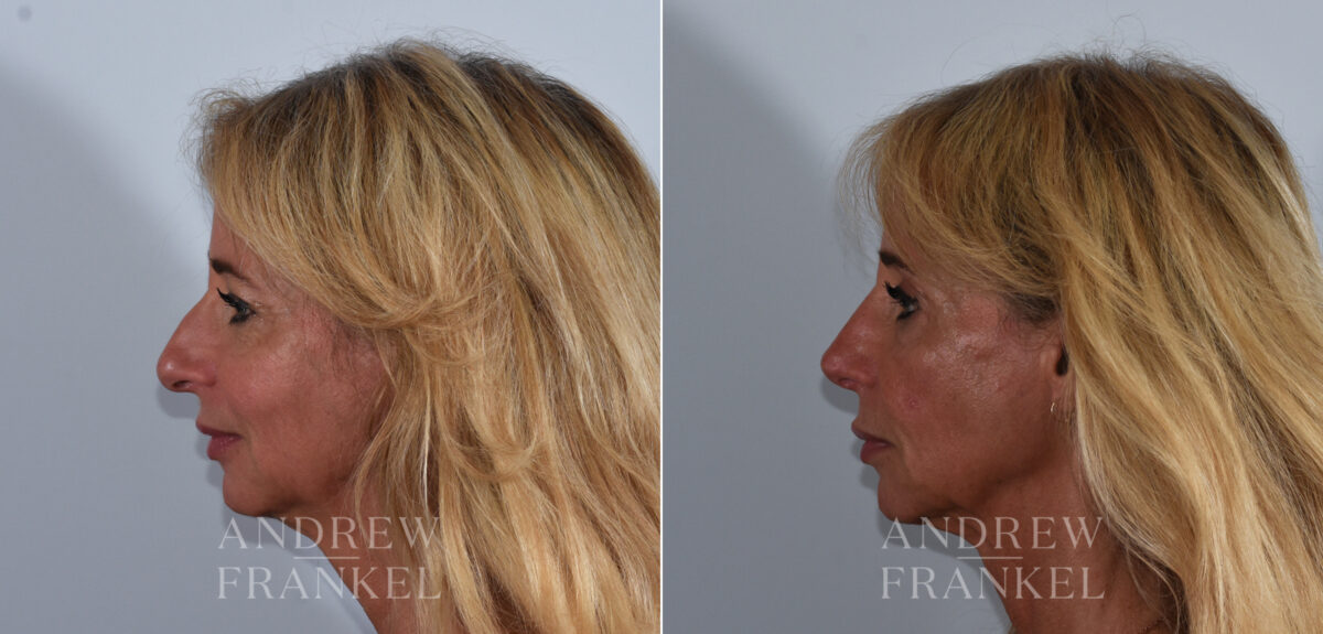 Rhinoplasty before and after photos in Beverly Hills, CA, Patient 24103