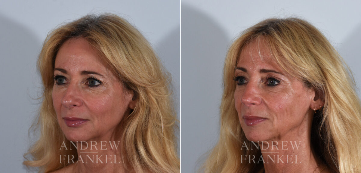 Rhinoplasty before and after photos in Beverly Hills, CA, Patient 24103