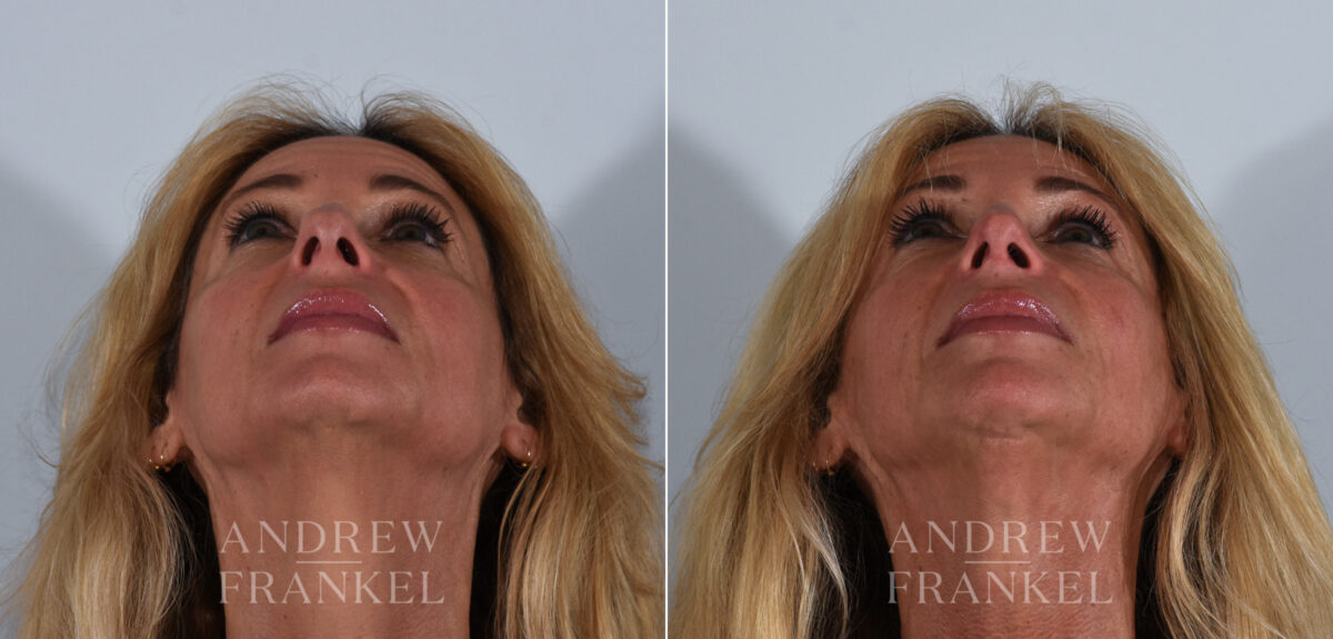 Rhinoplasty before and after photos in Beverly Hills, CA, Patient 24103