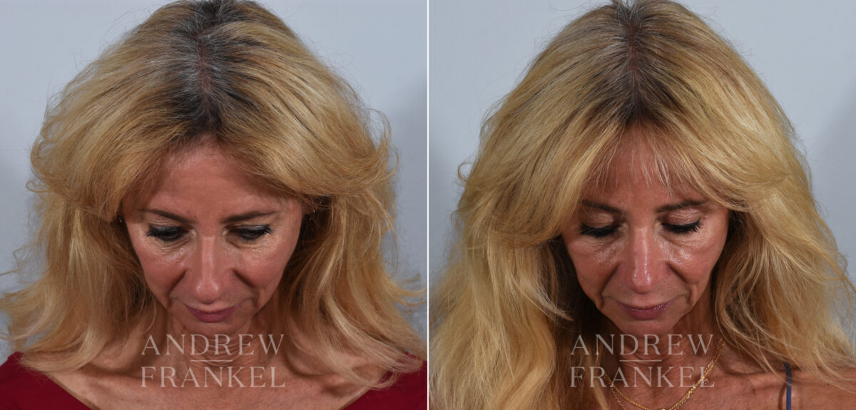 Rhinoplasty before and after photos in Beverly Hills, CA, Patient 24103