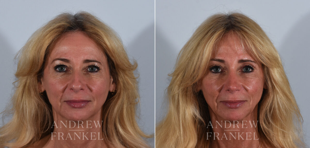 Rhinoplasty before and after photos in Beverly Hills, CA, Patient 24103
