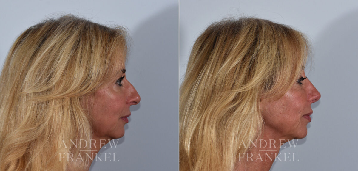 Rhinoplasty before and after photos in Beverly Hills, CA, Patient 24103