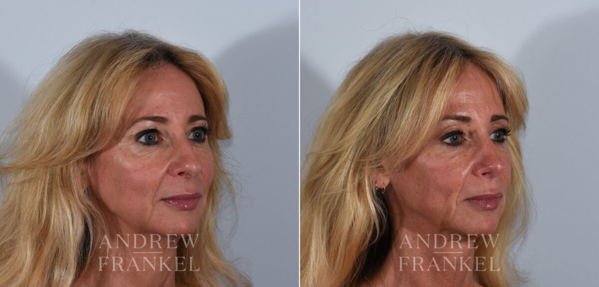 Rhinoplasty before and after photos in Beverly Hills, CA, Patient 24103