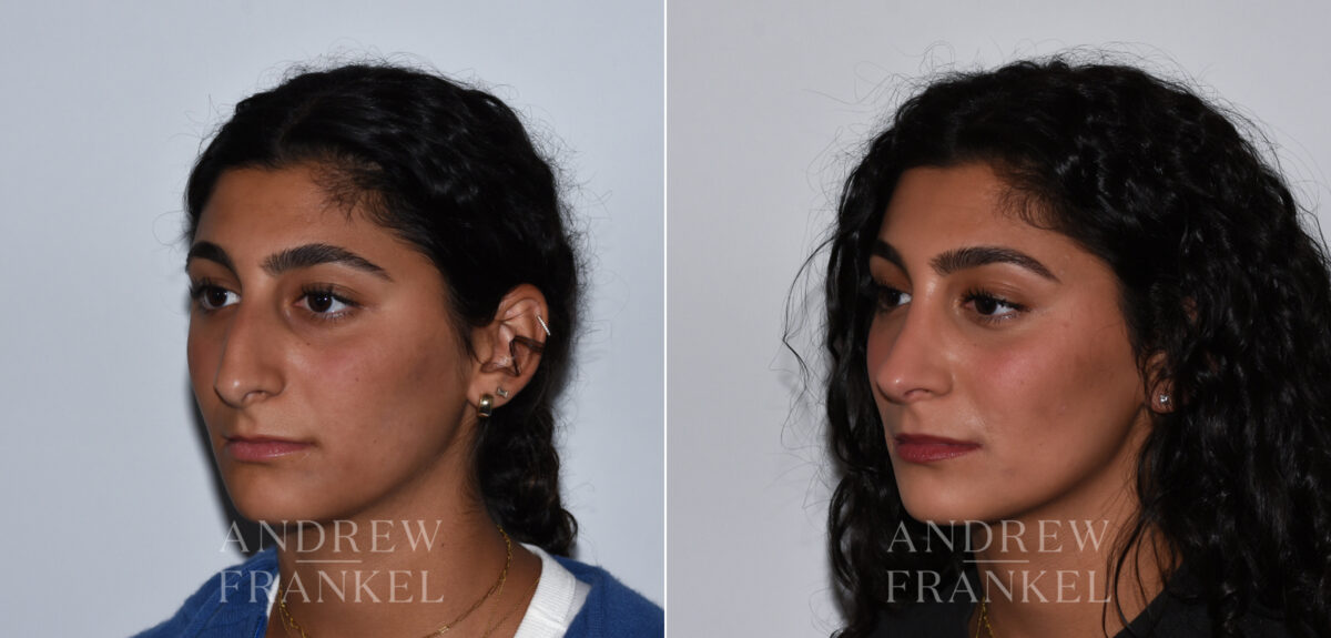 Rhinoplasty before and after photos in Beverly Hills, CA, Patient 24125