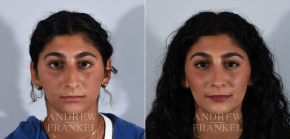 Rhinoplasty before and after photos in Beverly Hills, CA, Patient 24125