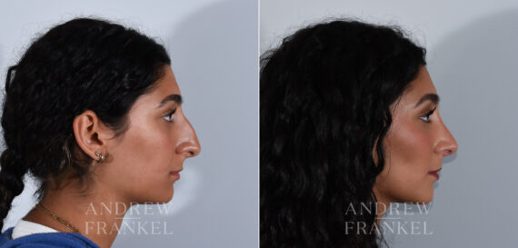 Rhinoplasty before and after photos in Beverly Hills, CA, Patient 24125