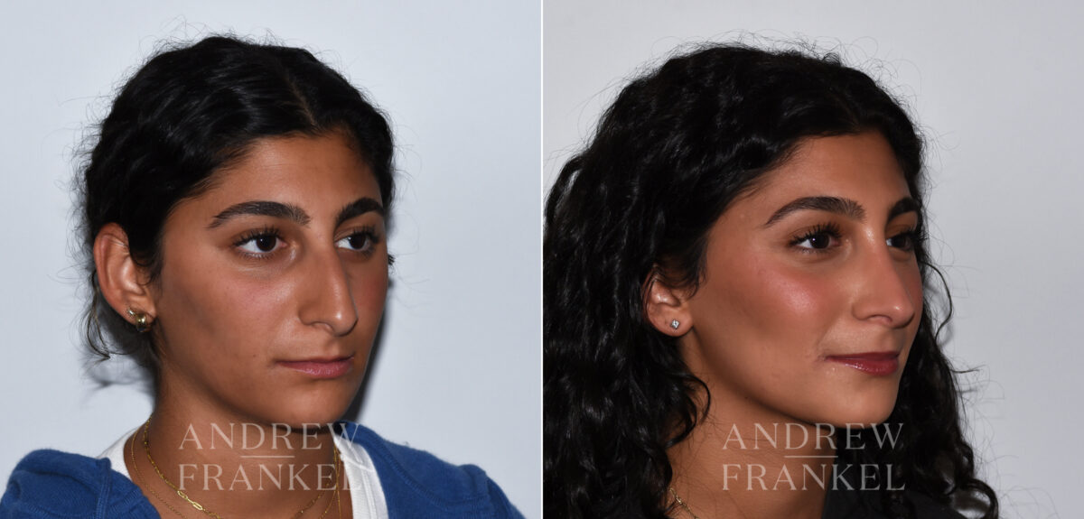 Rhinoplasty before and after photos in Beverly Hills, CA, Patient 24125
