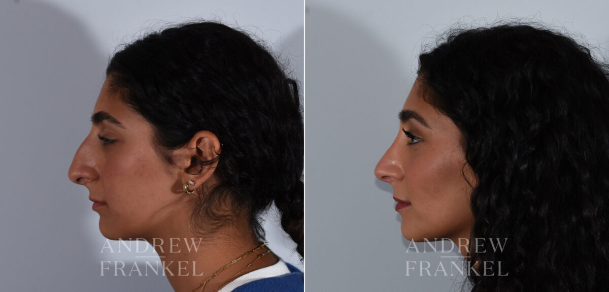 Rhinoplasty before and after photos in Beverly Hills, CA, Patient 24125