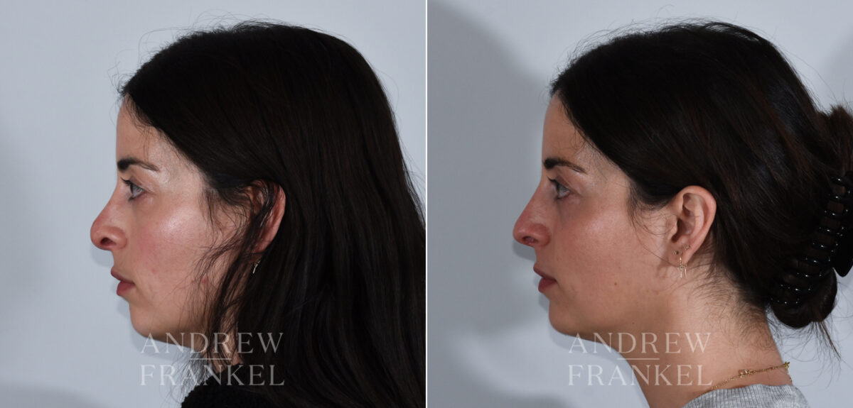 Revision Rhinoplasty before and after photos in Beverly Hills, CA, Patient 24144