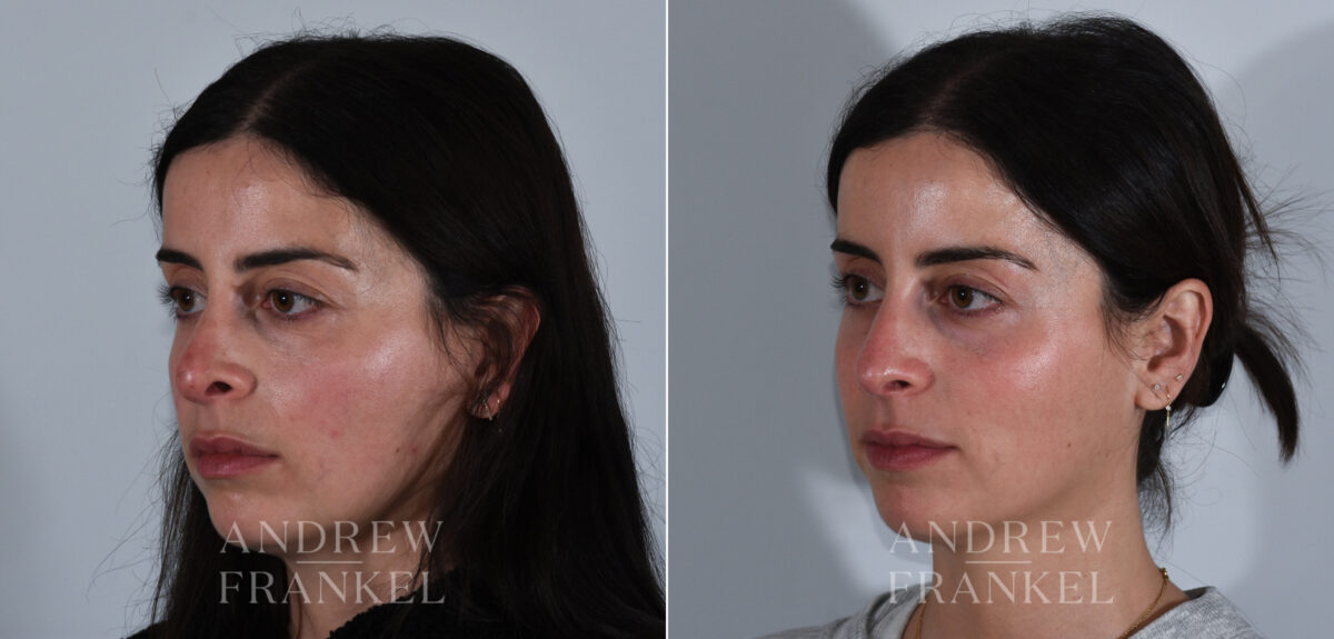 Revision Rhinoplasty before and after photos in Beverly Hills, CA, Patient 24144