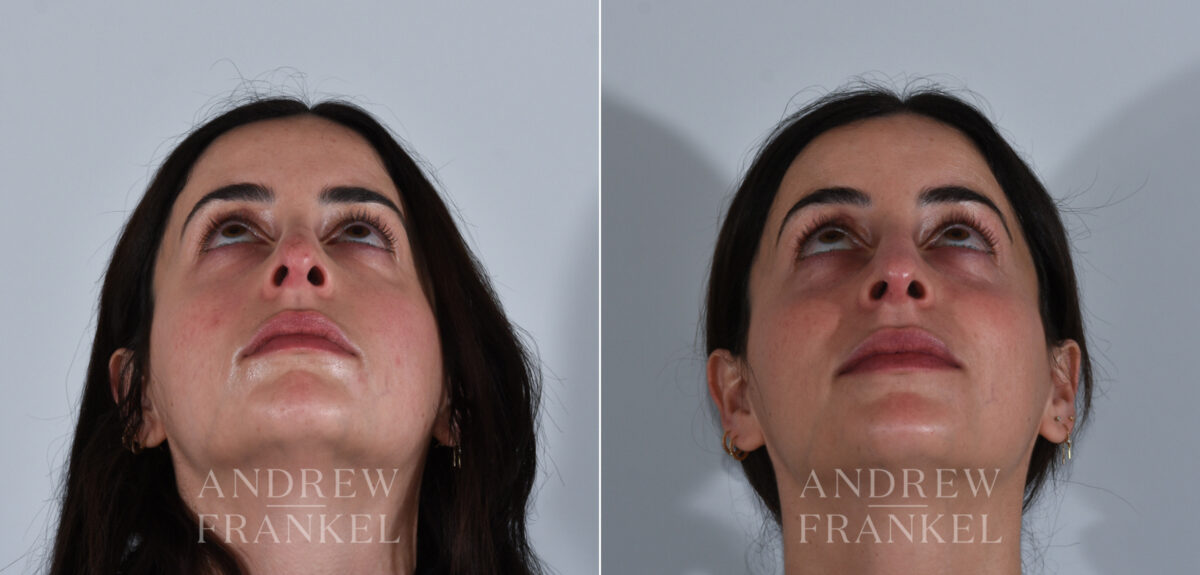 Revision Rhinoplasty before and after photos in Beverly Hills, CA, Patient 24144