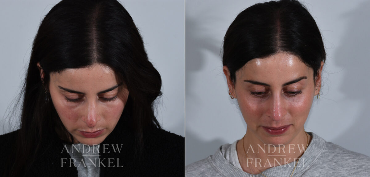 Revision Rhinoplasty before and after photos in Beverly Hills, CA, Patient 24144