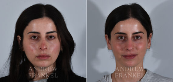 Revision Rhinoplasty before and after photos in Beverly Hills, CA, Patient 24144