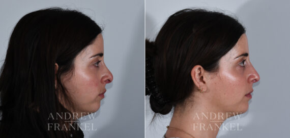 Revision Rhinoplasty before and after photos in Beverly Hills, CA, Patient 24144