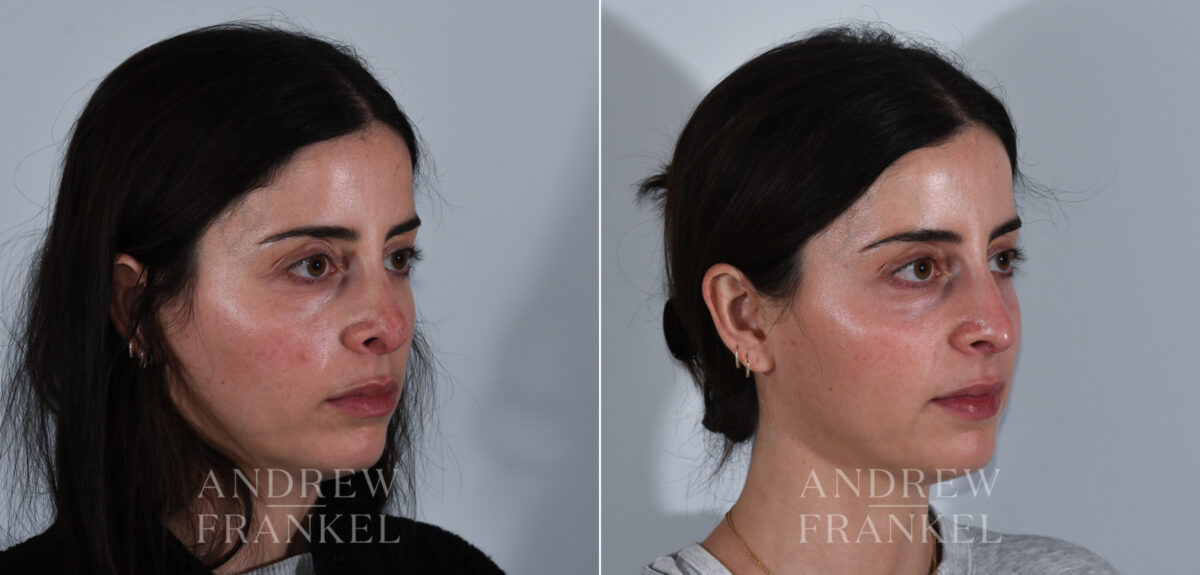 Revision Rhinoplasty before and after photos in Beverly Hills, CA, Patient 24144