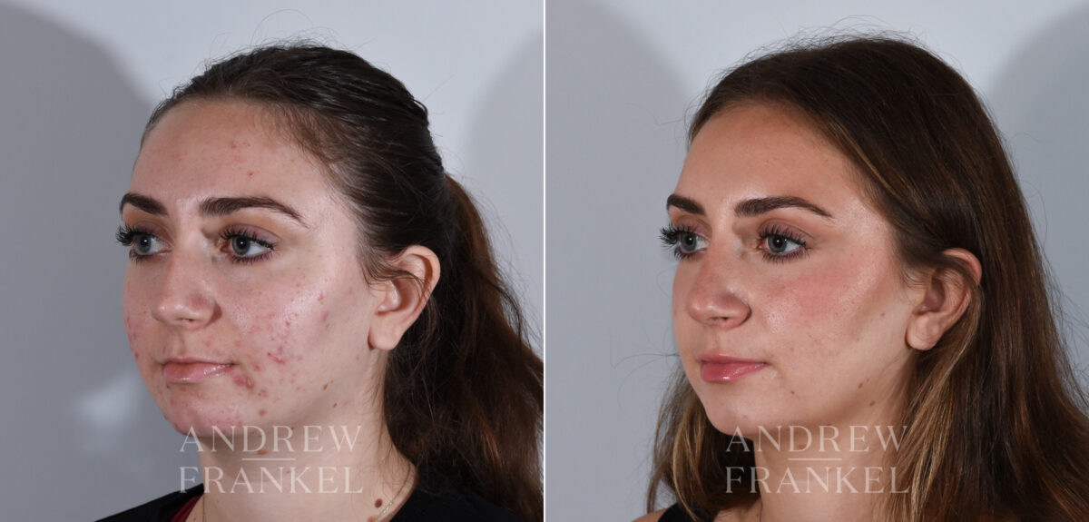 Rhinoplasty before and after photos in Beverly Hills, CA, Patient 24166