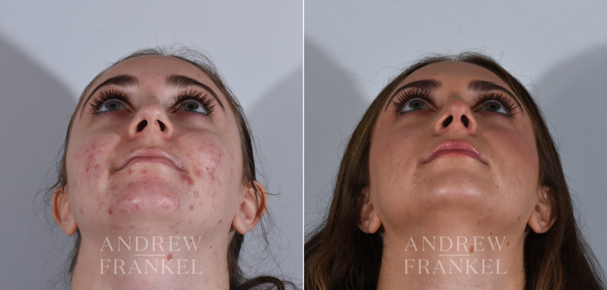 Rhinoplasty before and after photos in Beverly Hills, CA, Patient 24166
